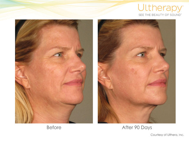 Ultherapy Neck Lift